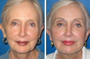 Before & After Photos